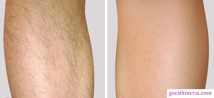 Chân trước và sau khi triệt lông