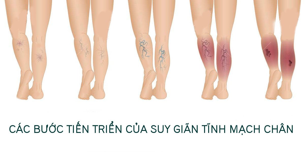 Giãn Tĩnh Mạch Chân Là Gì: Nguyên Nhân, Triệu Chứng Và Cách Điều Trị Hiệu Quả