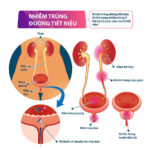 Nhiễm Khuẩn Tiết Niệu Là Gì? Triệu Chứng, Nguyên Nhân, Và Cách Điều Trị Hiệu Quả