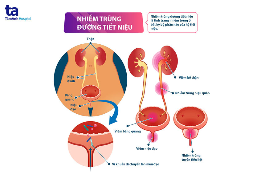 Nhiễm Khuẩn Tiết Niệu Là Gì? Triệu Chứng, Nguyên Nhân, Và Cách Điều Trị Hiệu Quả