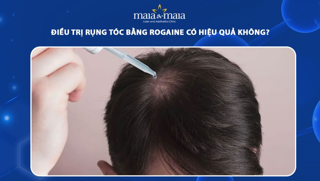 Rogaine Là Gì? Khám Phá Hiệu Quả Và Cách Sử Dụng Điều Trị Rụng Tóc