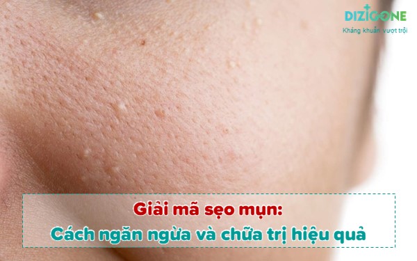 Cách Phòng Ngừa Mô Sẹo