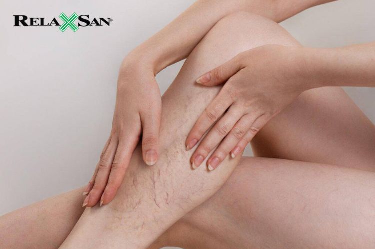 Những Câu Hỏi Thường Gặp Về Giãn Tĩnh Mạch Chân